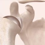 Primary Shoulder Replacement Patient Animation
