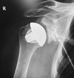 Equinoxe Stemless Shoulder Xray